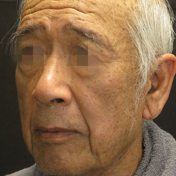 PicoSure before and after 22