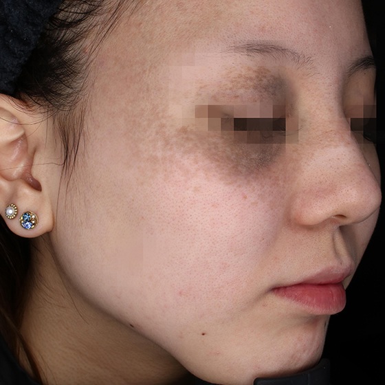 PicoSure before and after 3