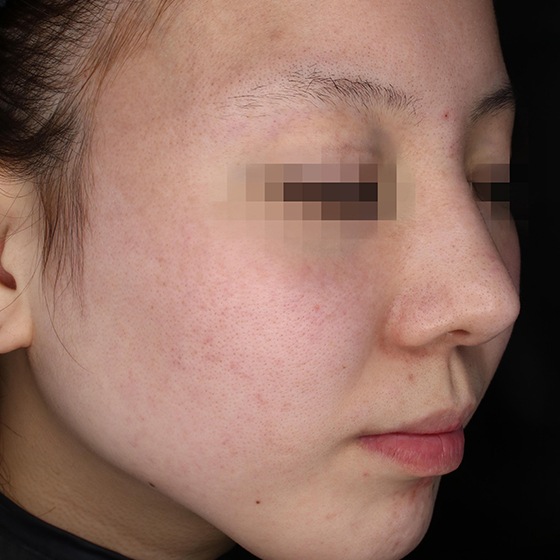 PicoSure before and after 4