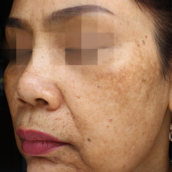 PicoSure before and after 5