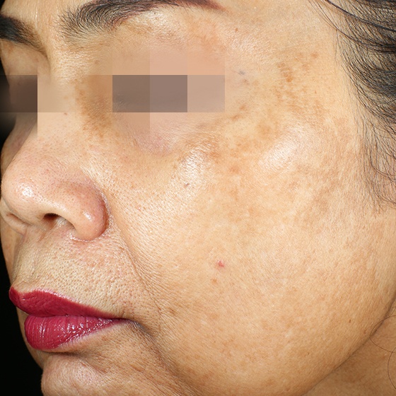PicoSure before and after 6