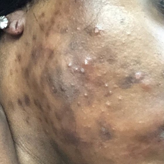 PicoSure before and after 7