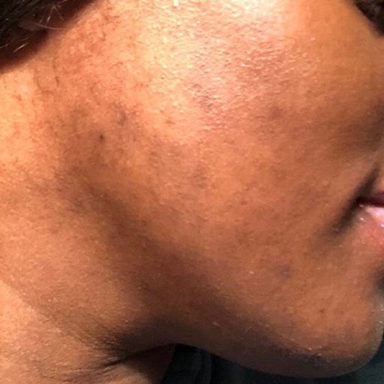 PicoSure before and after 8