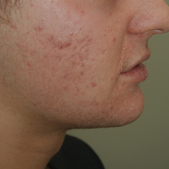 PicoSure before and after 9