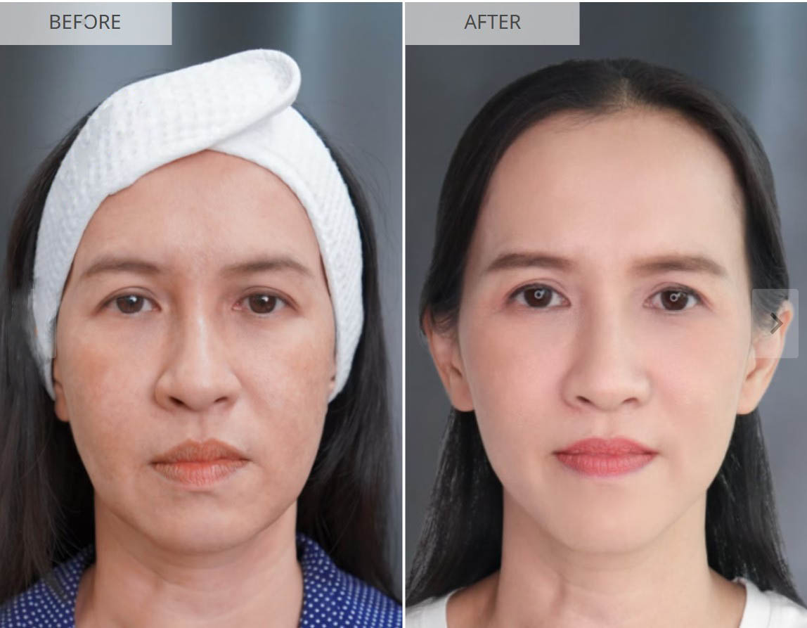 Sculptra before and after result 1