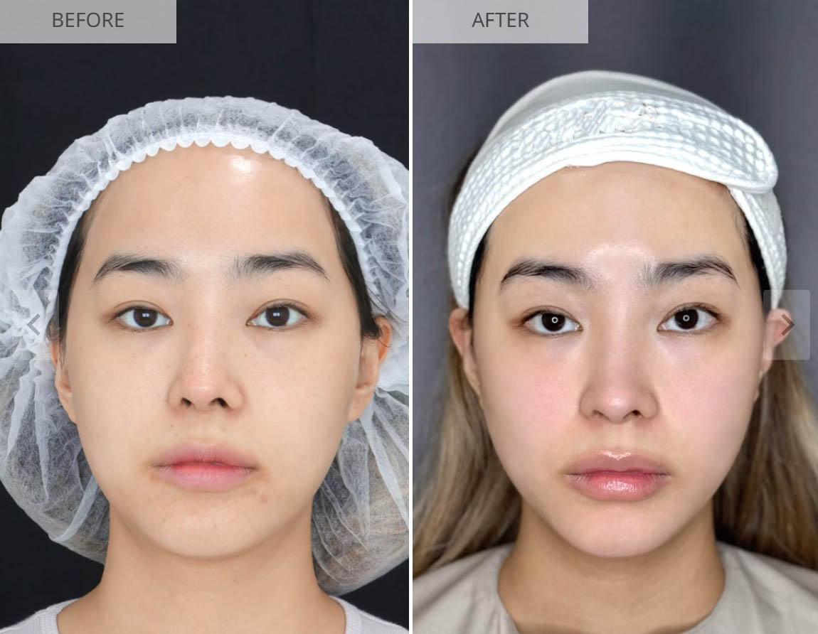 Sculptra before and after result 2