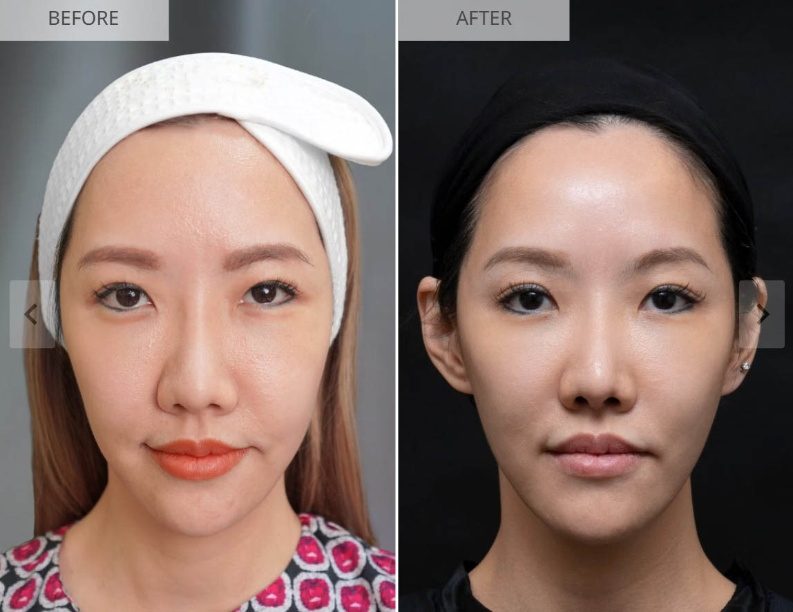 Sculptra before and after result 3