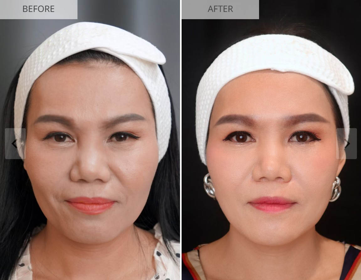 Sculptra before and after result 4