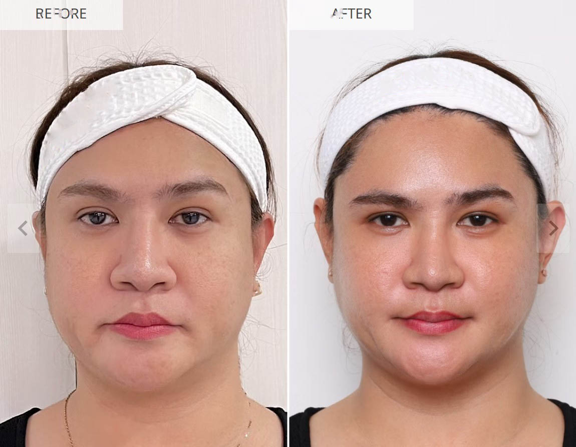 Sculptra before and after result 5