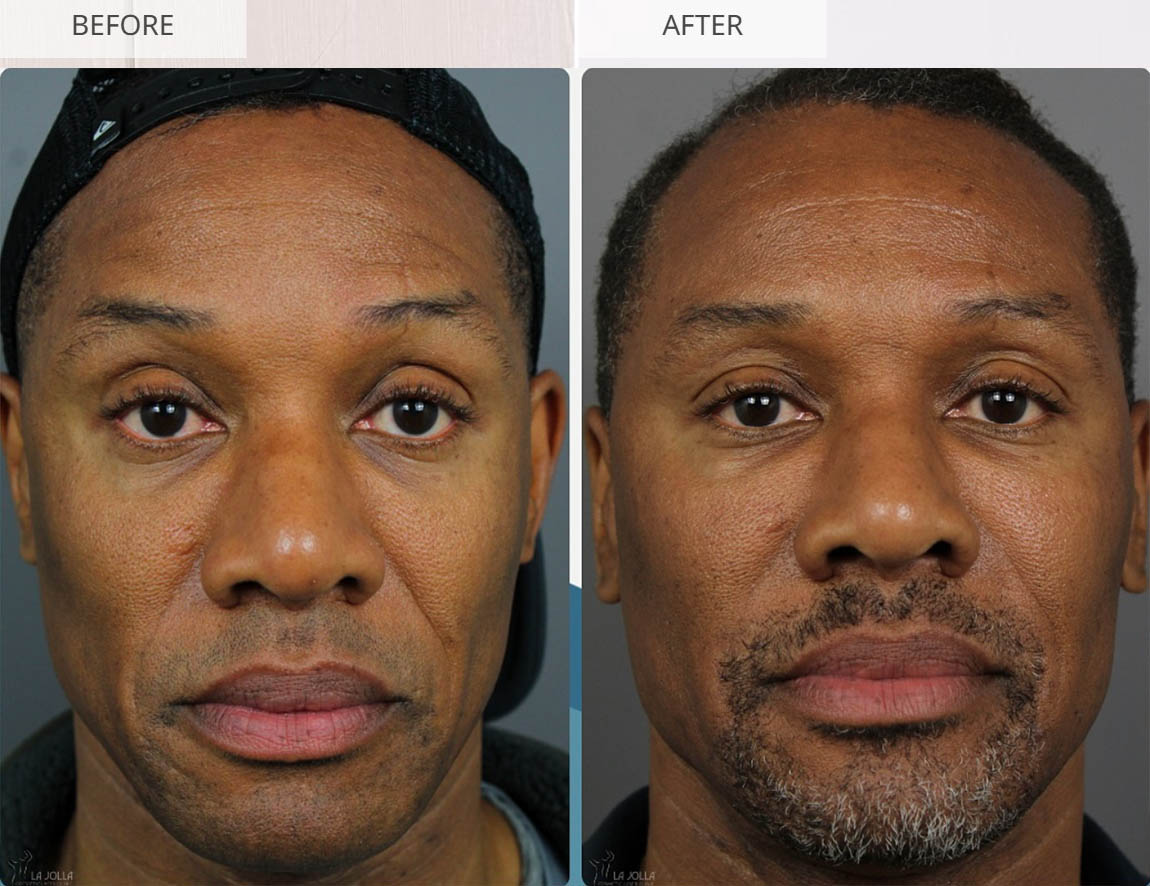 Sculptra before and after result 6
