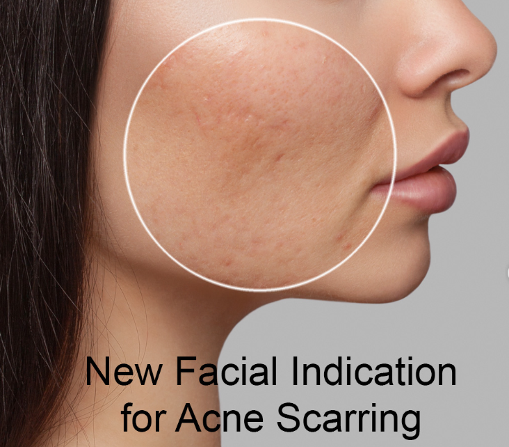 Microneedling benefits for fine lines, wrinkles, and skin texture improvement