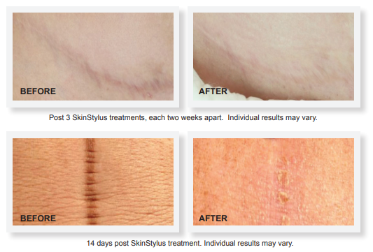 FDA-cleared SkinStylus treatment results for acne and trauma scars