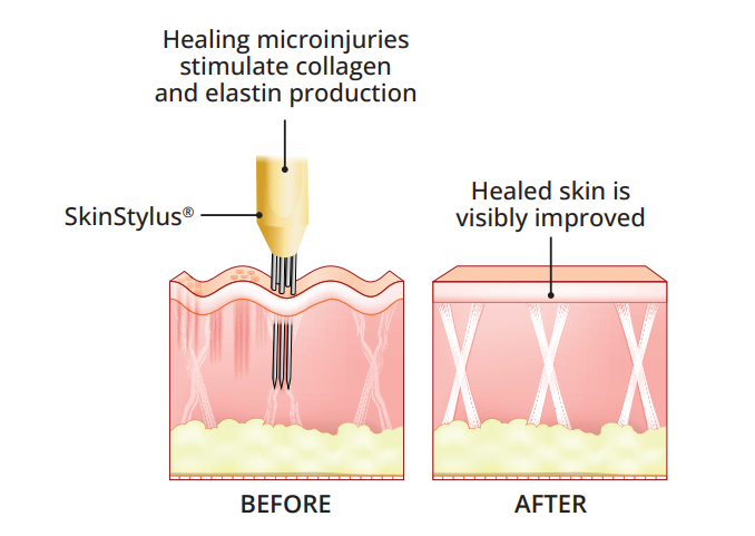 Professional microneedling procedure for scar reduction and skin rejuvenation