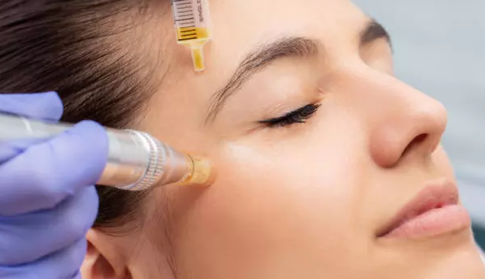 SkinStylus microneedling device for collagen induction therapy and scar treatment