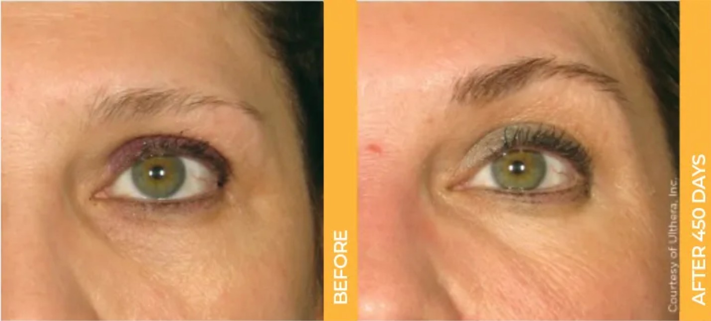 Ultherapy result 10
