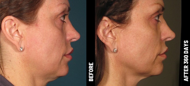 Ultherapy result 1