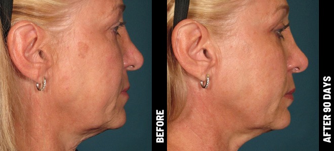 Ultherapy result 2