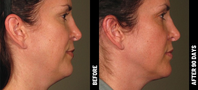Ultherapy result 3