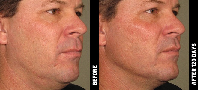 Ultherapy result 4