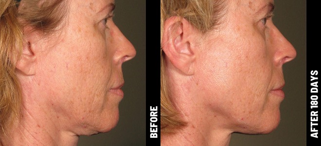 Ultherapy result 5
