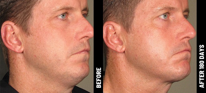 Ultherapy result 6