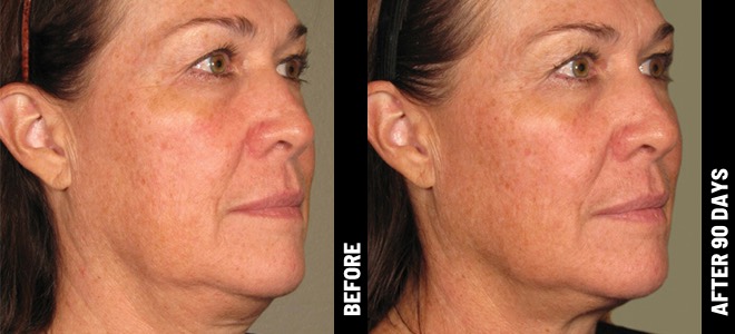 Ultherapy result 7
