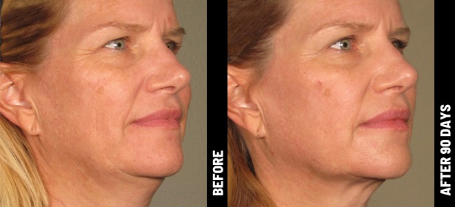 Ultherapy result 8