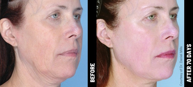 Ultherapy result 9
