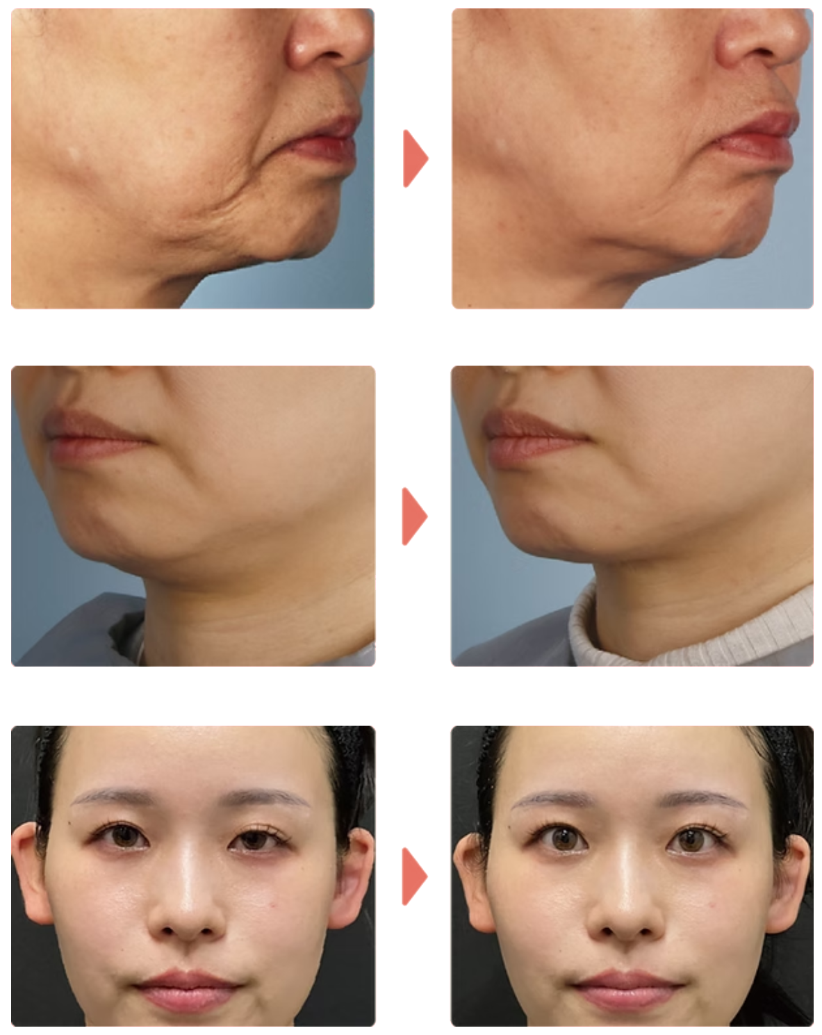 XERF before and after